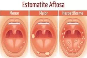Como Tratar Estomatite Em Bebe - Estomatite no bebê: o que é, sintomas e tratamento - Med