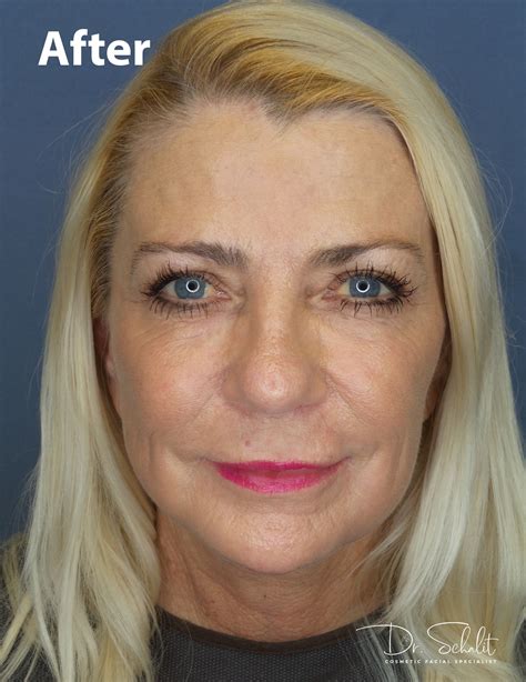Face & Neck Lift 26 - Dr. Schalit Cosmetic Facial Specialist