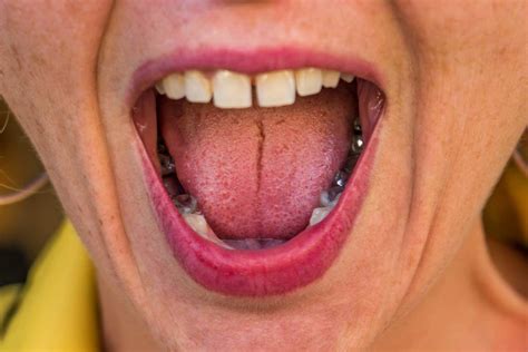 10 Enfermedades de la Lengua y Tratamientos | Clínica Sorias