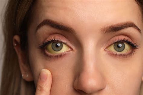 Yellow Fever Skin Yellow Fever: International History, U.S. Risk,