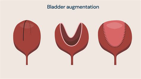 bladder augmentation  mitrofanoff procedure  high pressure