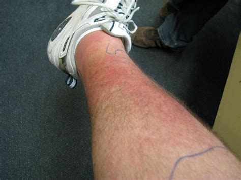 Bactrim Skin Rash