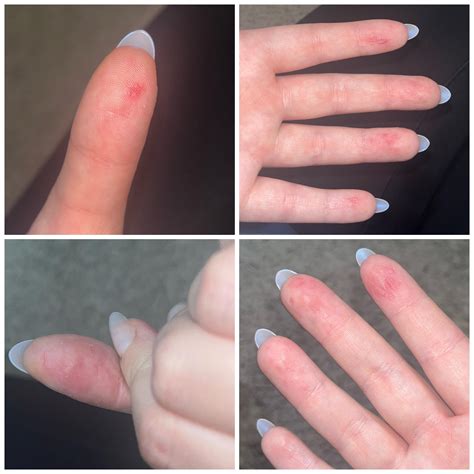 Peeling and itchy skin on fingers? Anyone else experience this? Photo