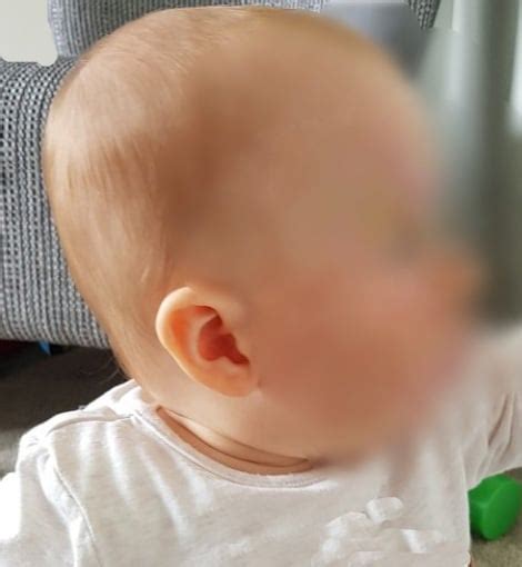 flat head syndrome flat head syndrome treatment