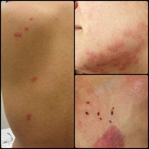 OKC Pest Control Reports The Return Of Bed Bugs: Part 2 | The Bug Guy