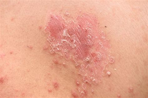 Psoriasis and Breastfeeding - Is it Safe & Tips to Manage
