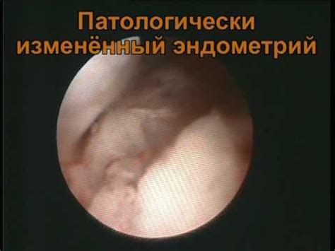 Рак эндометрия. Гистероскопия. Биопсия. - YouTube
