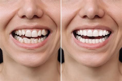 clear aligners greater las vegas dental