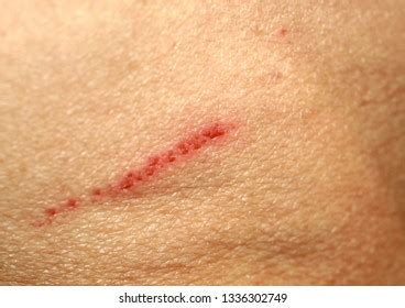 wound cut  skin abrasion  stock photo  shutterstock