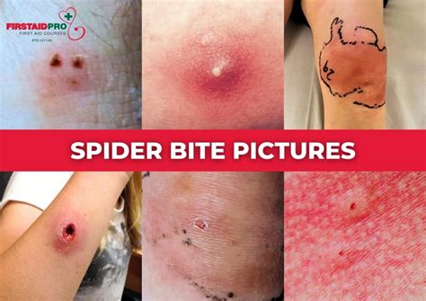 spider bite identification chart Helpful spider chart