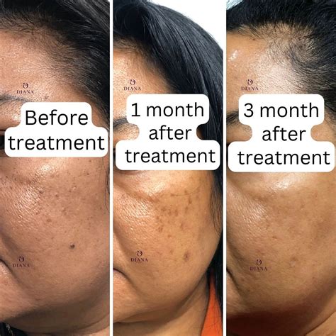 Treatment Downtime – Dr Diana Clinic