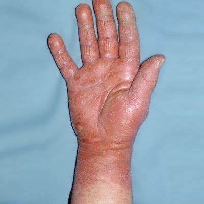 Skin Problems of Olympic Athletes - Skin and Beauty Center - Everyday ...