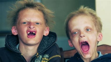 Porphyria: The Vampire Disease by Dr. Peter W. Kujtan