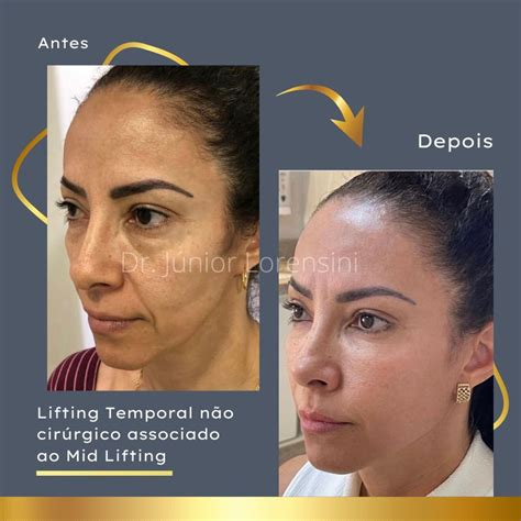 Lifting Não Cirúrgico Antes E Depois