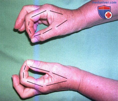 Синдром запястного канала: атлас фотографий