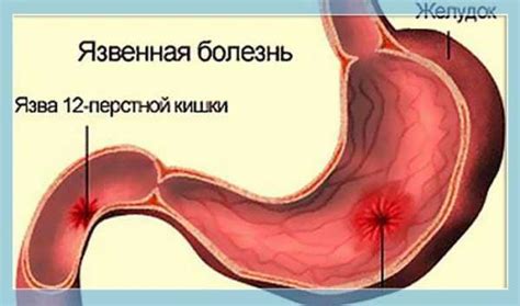 Язва двенадцатиперстной кишки симптомы и лечение фото – язва (12 ...