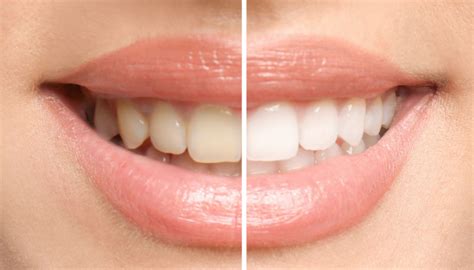 Teeth Whitening Sandpoint, Idaho – Northern Peaks Dental