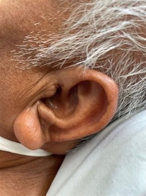 Bilateral Earlobe Crease (Frank’s Sign) and Multifocal Vascular Disease