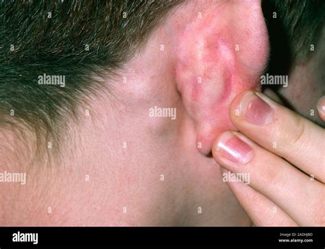Posterior Auricular Lymph Nodes Swollen