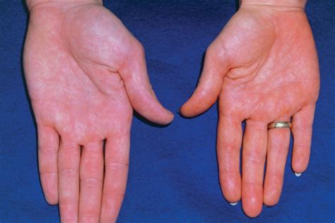 yellow spots  skin jaundice