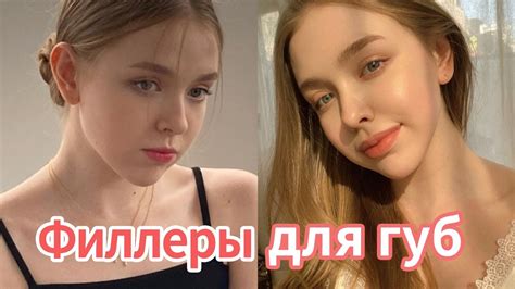 Филлеры для увеличения губ в Корее - YouTube