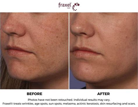 Fraxel Skin Resurfacing Treatment
