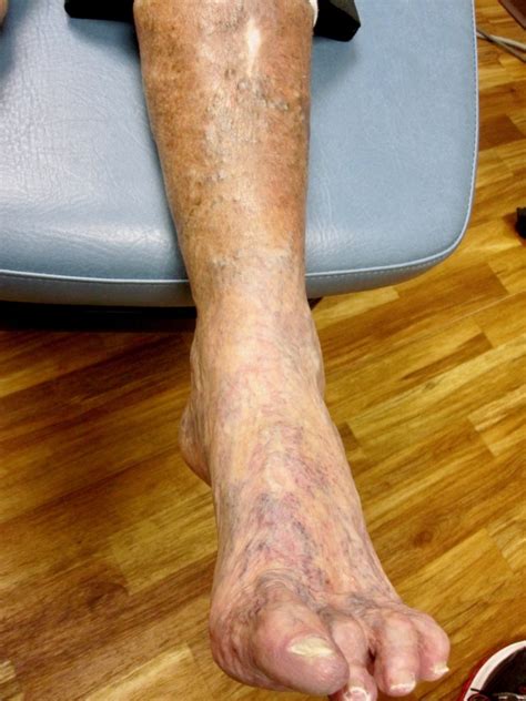 vascular disease