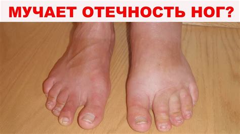 Эффективное лечение отечности ног с помощью народных средств