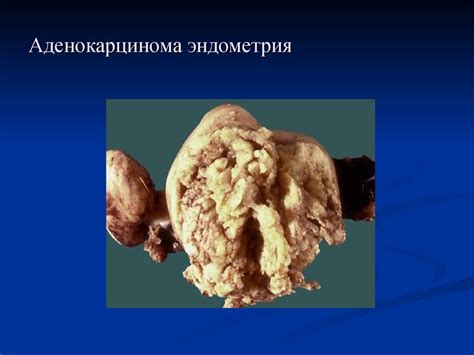 Гиперпластические процессы эндометрия. Рак эндометрия - презентация онлайн