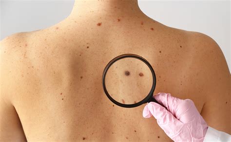 Melanoma Cases and Deaths Predicted to Rise in the Next Two Decades ...