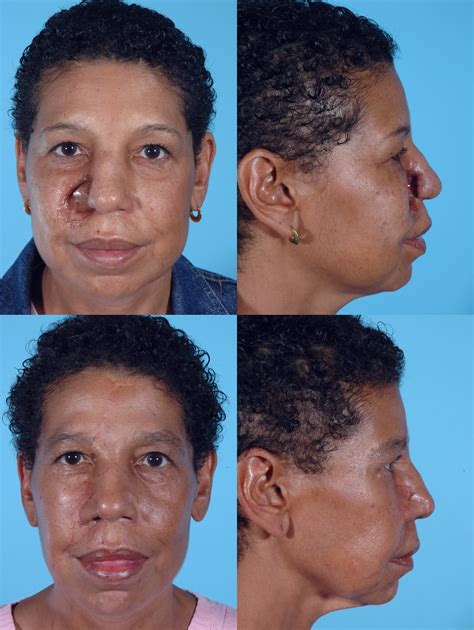 NASAL RECONSTRUCTION GALLERY « Wolfe