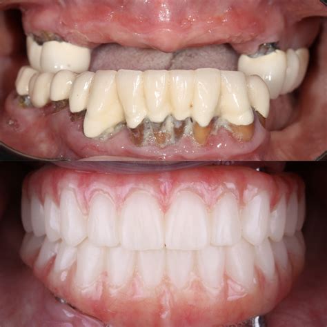 Имплантация по системе «Все на четырех» в Academic Dentistry ...