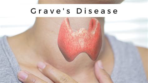 Neonatal Graves Disease