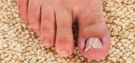 Toenail Problems - Ipswich Podiatry Centre