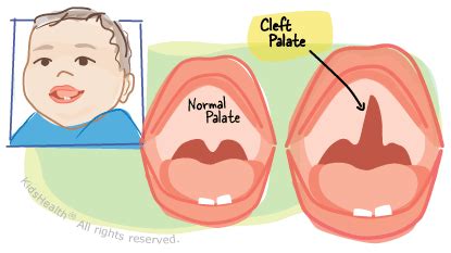 cleft lip  palate neonatal journey  home