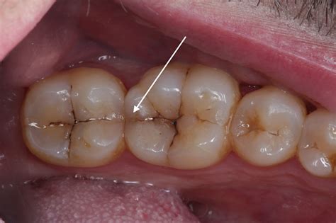 bleeding  cracked tooth