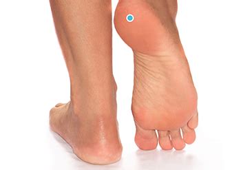 Excessive pronation of the foot