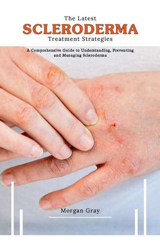 The Latest Scleroderma Treatment Strategies: A Comprehensive Guide to ...