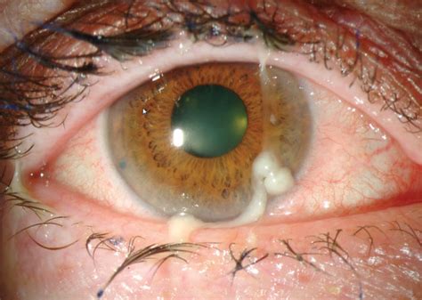bacterial  viral conjunctivitis
