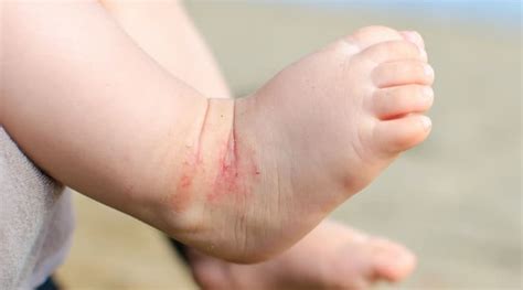 Best Remedies for Baby Eczema (ultimate list) – Habitat for Mom