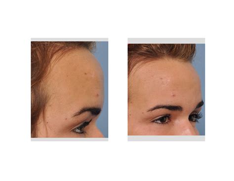 Protruding Forehead