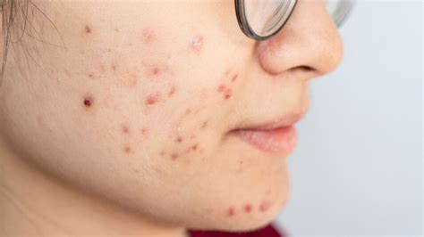acne  dairy products  bad   skin