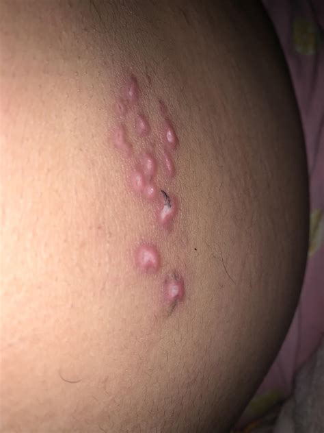 Am I contagious while my shingles look like this? They were scabbing