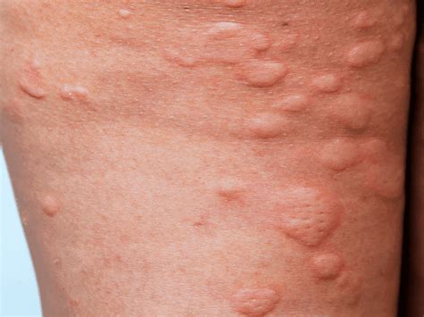 Itchy Skin Hives