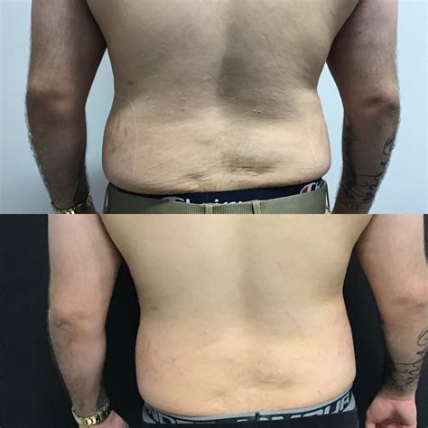 male   elite body contouring  northern virginia ultra