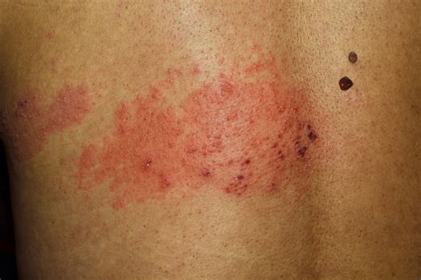 Stages of shingles | Virtuwell