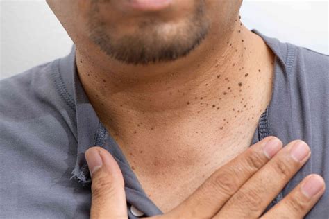 Skin Tag Removal: How and When To Do It