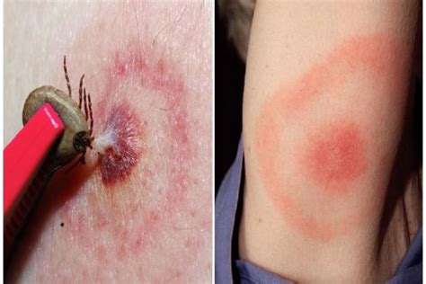 Lyme disease | Diagnosis & treatment in Turkey