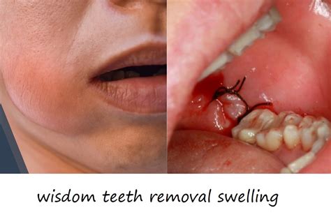 long  swelling  wisdom tooth extraction detroit chinatown