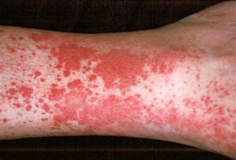 Vasculitis